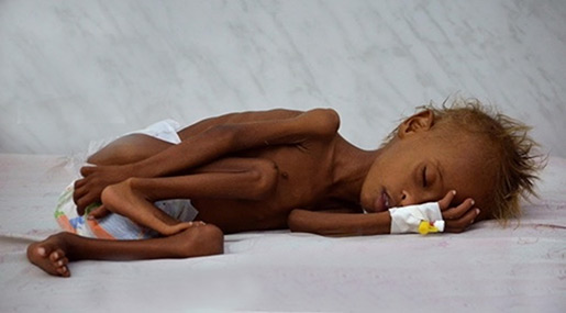 The Starved Children of Yemen