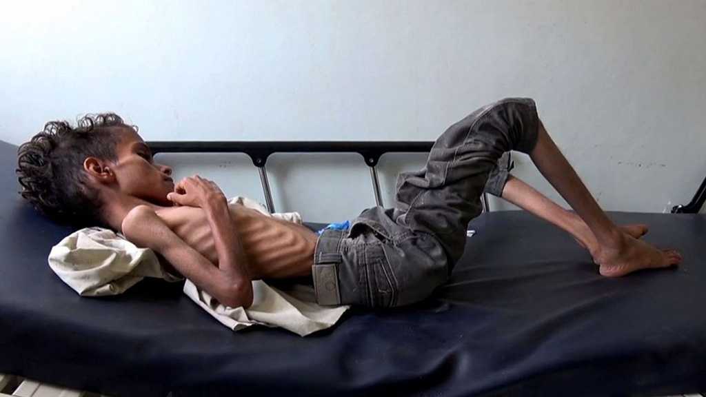 Yemen: 85,000 Children May Have Died from Starvation due to Saudi War 