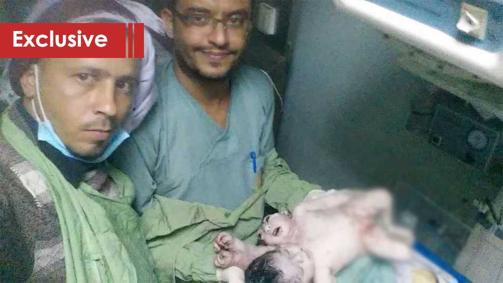 Another Extremely Rare Conjoined Twins Died In Sana’a Far From Western Media Attention