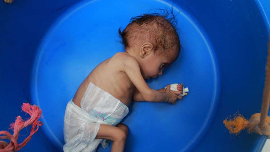 Child Malnutrition Surges in Yemen - UN