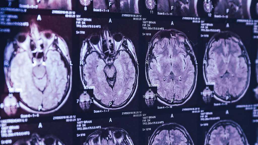 Doctors Investigate Mysterious Brain Disease Cluster in Canada