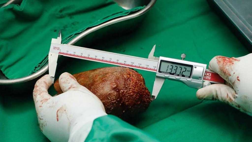 Miscellaneous:World's Largest Kidney Stone Removed