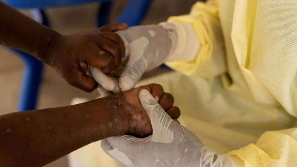 WHO: Mpox Spread A Public Health Emergency 