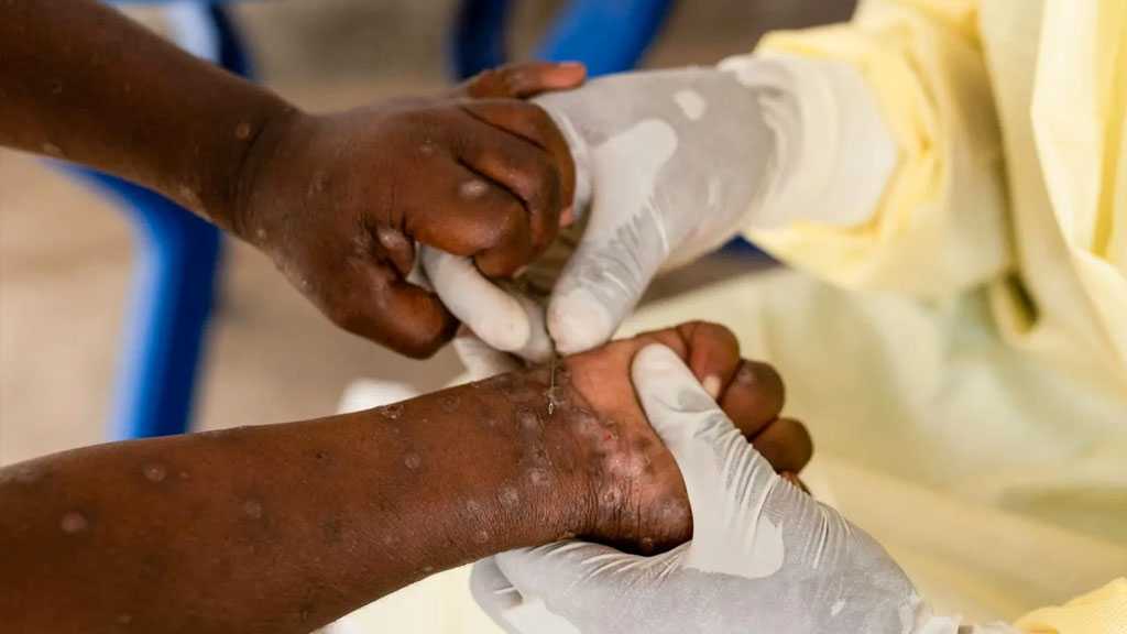 Africa: MPox Outbreak Raises UN Concerns